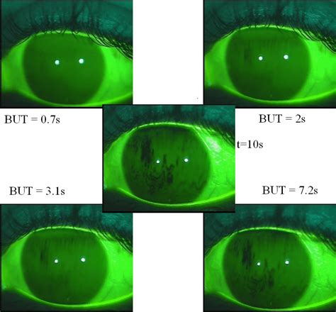 tear film break up test|diagnostic test for dry eyes.